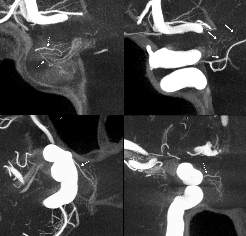 Superior Hypophyseal Artery